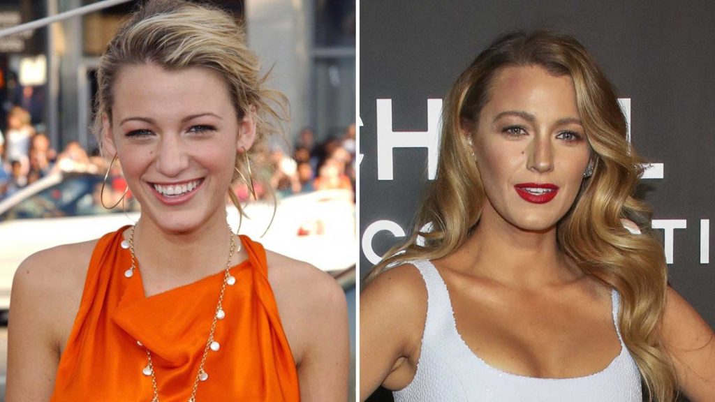 Blake Lively Plastic Surgery