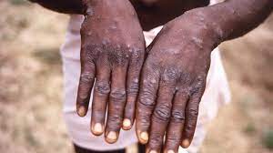 Mpox in Africa